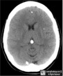 Cysticercosis
